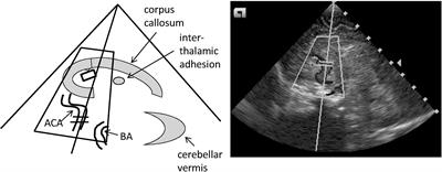 Supine vs. Prone Position With Turn of the Head Does Not Affect Cerebral Perfusion and Oxygenation in Stable Preterm Infants ≤32 Weeks Gestational Age